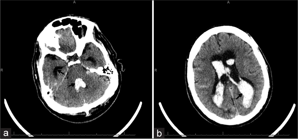 60-year-old male who presented unresponsive and found to have a large intraventricular hemorrhage. (a and b) The patient’s presenting head computed tomography without contrast showing diffuse intraventricular hemorrhage with casting of the 4th ventricle and filling the lateral ventricles (closed arrows) and prominent hydrocephalus with enlarged temporal horns (open arrow). Imaging is equivalent to a modified Graeb score 26 and Le Roux 14.