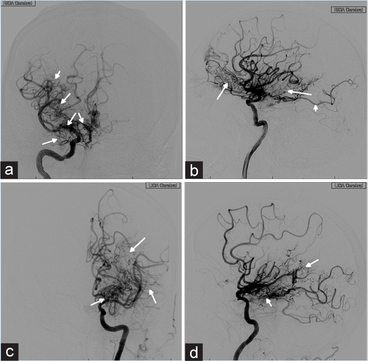 60-year-old male who presented unresponsive and found to have a large intraventricular hemorrhage. Cerebral angiogram on admission. (a) AP view of injection of the right internal carotid artery. There is prominent stenosis of middle cerebral and anterior cerebral arteries (open arrows) as well as diffuse collateral development (closed arrows). (b) Lateral view of right internal carotid artery injection showing diffuse collateral formation (closed arrows) as well as a fetal origin of the posterior cerebral artery (PCA, open arrow). (c) AP view of injection of the left internal carotid (ICA) artery with moderate stenosis of the terminus (open arrow) and prominent collateral circulation (closed arrows). (d) Lateral view of injection of the left ICA with collaterals (closed arrows).