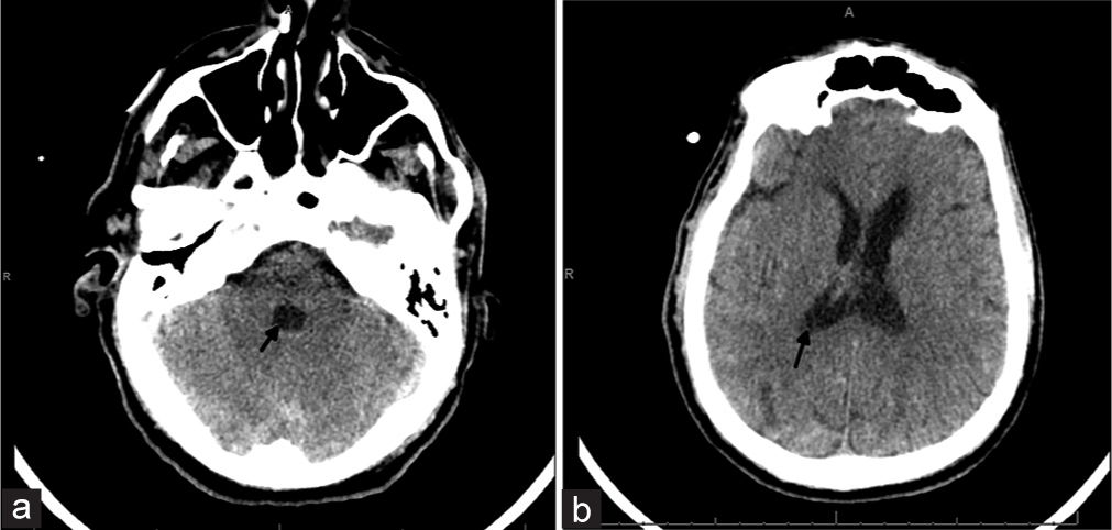 60-year-old male who presented unresponsive and found to have a large intraventricular hemorrhage. Head computed tomography obtained at the end of treatment with intraventricular tPA. (a and b) There is decompression and complete resolution of clot in the 4th ventricle and minimal clot remaining in the lateral ventricles (closed arrows) with no appreciable hydrocephalus. Imaging is equivalent to a modified Graeb score 6, and Le Roux 4.