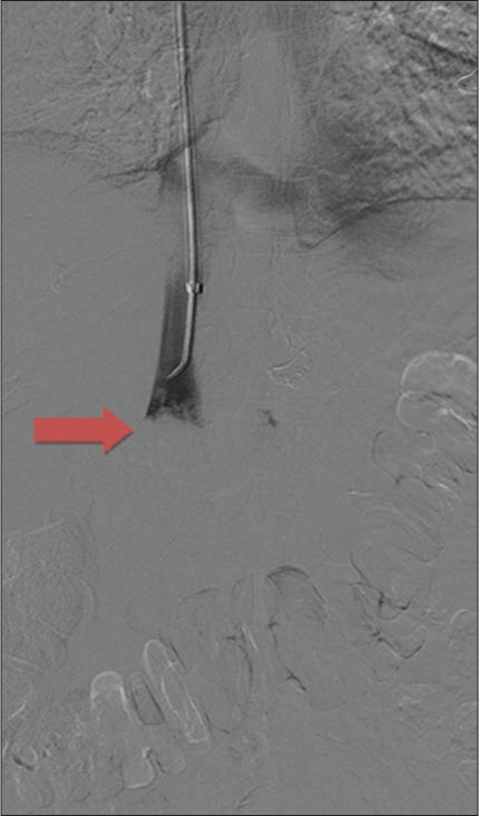 An 81-year-old female presenting with progressively worsening pelvic and back pain. Digital subtraction angiography of the upper abdomen demonstrates a large intraluminal filling defect in the inferior vena cava (red arrow).
