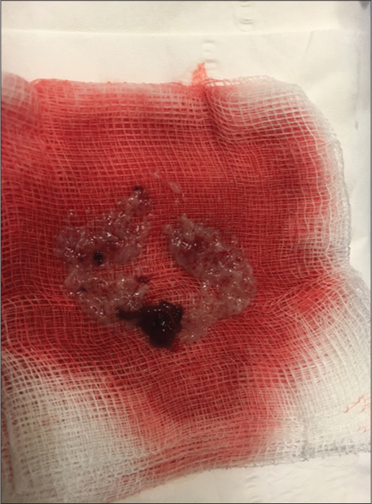 An 81-year-old female presenting with progressively worsening pelvic and back pain. Photograph of a representative gross sample of aspirate of the intraluminal mass.