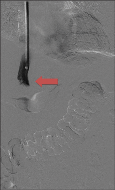 An 81-year-old female presenting with progressively worsening pelvic and back pain. Digital subtraction angiography post biopsy demonstrates patency of the intrahepatic inferior vena cava superior to the mass and no evidence of extravasation (red arrow).