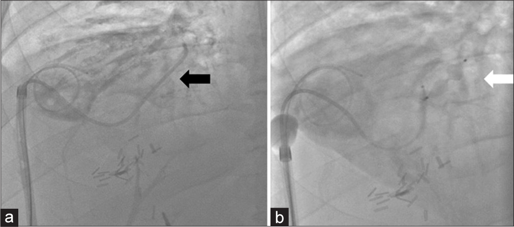 A 52-year-old male with a bronchobiliary fistula (BBF) secondary to chemotherapy-induced biliary stricturing presents for fistulogram and percutaneous embolization. (a) Single spot fluoroscopic image displays a bright tip sheath which was exchanged over a wire after removal of the previously existing biloma drainage catheter. The BBF was cannulated with a Berenstein catheter (black arrow) and an Amplatzer vascular plug 4 was placed. (b) Single spot fluoroscopic image demonstrates a microcatheter advanced through the Berenstein catheter for glue embolization of the BBF track utilizing the vascular plug as scaffolding (white arrow).