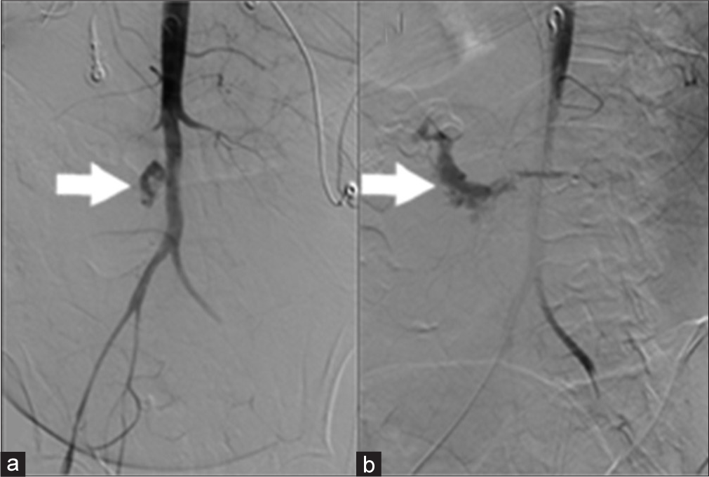 44-year-old female with aortoenteric fistula. (a) Aortogram demonstrates extravasation of contrast from the aorta (white arrow). (b) Delayed image after aortogram demonstrates contrast pooling in the duodenum (white arrow).