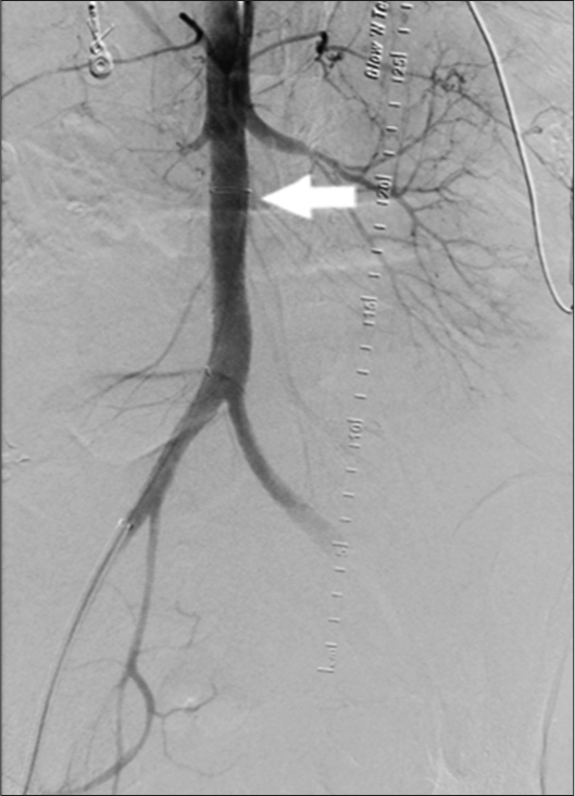 44-year-old female with aortoenteric fistula. Aortogram post graft (white arrow) placement demonstrates adequate control of the fistula with no further extravasation.