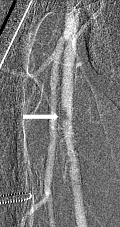 63-year-old man with chronic kidney disease and atherosclerosis presenting with non-healing right toe ulcers and rest pain due to infrapopliteal arterial occlusive disease, who underwent endovascular revascularization via antegrade SFA access with Angio-Seal closure. Carbon dioxide digital subtraction angiography of the right thigh immediately after Angio-Seal deployment demonstrates a discrete ovoid eccentric filling defect in the proximal right SFA at the earlier puncture site.