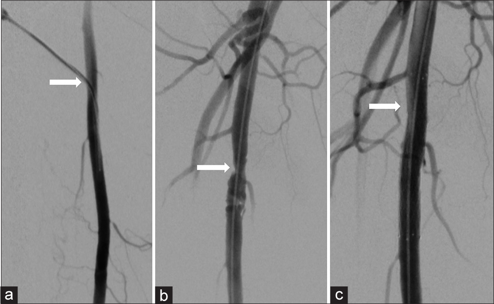 (a) 52-year-old woman presenting with non-healing right foot ulcers due to infrapopliteal arterial occlusive disease, who underwent endovascular revascularization via antegrade SFA access with Angio-Seal closure. Her symptoms later recurred, and she returned for repeat angiography 17 months later. Digital subtraction angiography of the right thigh demonstrating a 5-french sheath (arrow) entering the widely patent proximal right SFA during her original procedure, (b) Digital subtraction angiography of the right thigh 17 months later demonstrating irregular stenosis (arrow) at the prior superficial femoral artery puncture site, (c) Magnified digital subtraction angiography of the right thigh following angioplasty and stenting shows no significant residual stenosis.