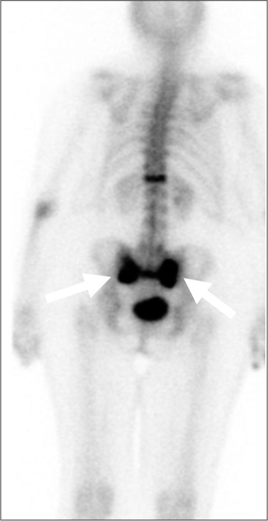 A 72-year-old female with known sacral insufficiency fracture. Posterior planar bone scintigraphy. demonstrates the classic H-shaped uptake, seen in a Denis type 3 sacral fracture.