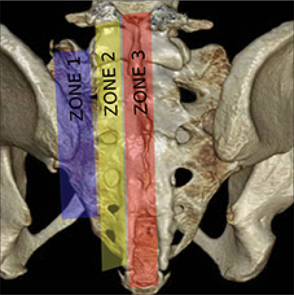 A three-dimensional volume rendered computed tomographic image of the sacrum with the demarcated zones described in the Denis classification of sacral fractures.