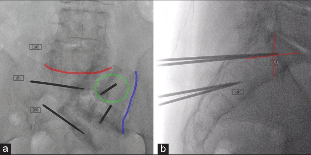 Ideal fluoroscopic views and needle placement for posterior approach sacroplasty. (a) Anterior oblique view with L5–S1 (red line) and the sacroiliac joint (blue line) aligned with the detector. The needle within the left S1 wing is advanced face (green circle). (b) Target of S1 needle tip at the intersection of lines drawn from the corners of S1.