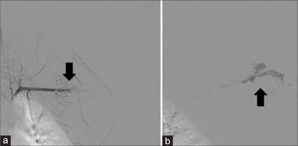 41 year-old male with axillary artery transection. (a) Angiogram showing traumatic injury of the axillary artery with active extravasation. (b) Active extravasation into the left axillary hematoma