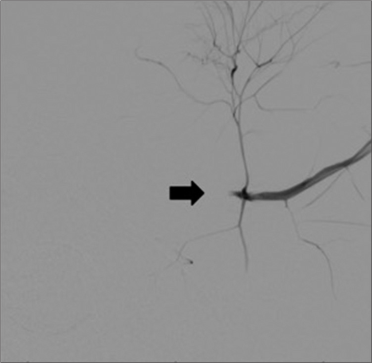41 year-old male with axillary artery transection. Retrograde angiography confirms transection with retraction of the axillary artery stump
