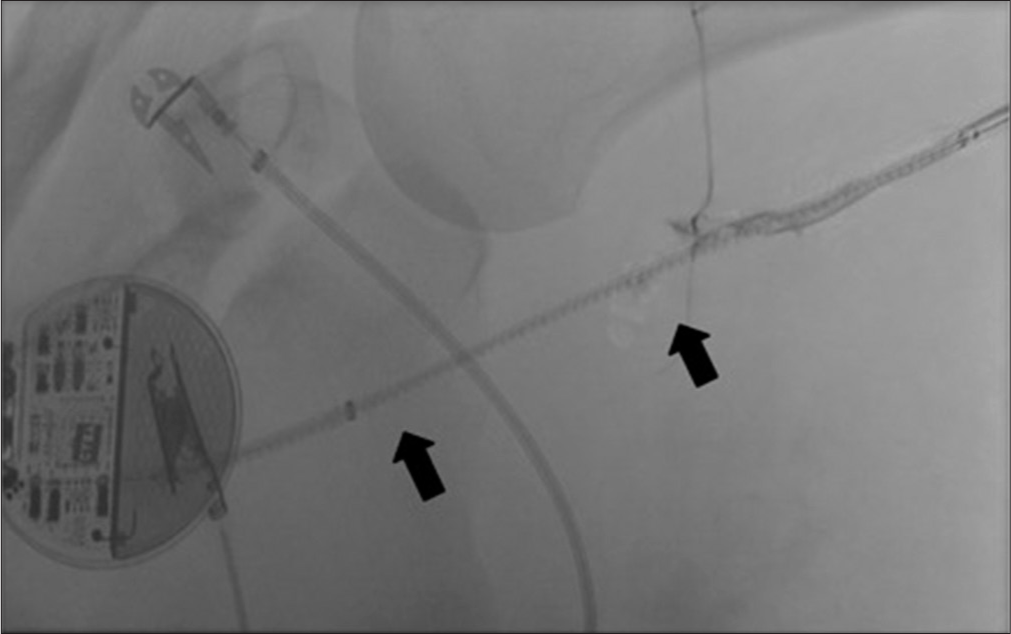 41 year-old male with axillary artery transection. Angiogram showing Viabahn stent positioning following traversal of axillary artery transection