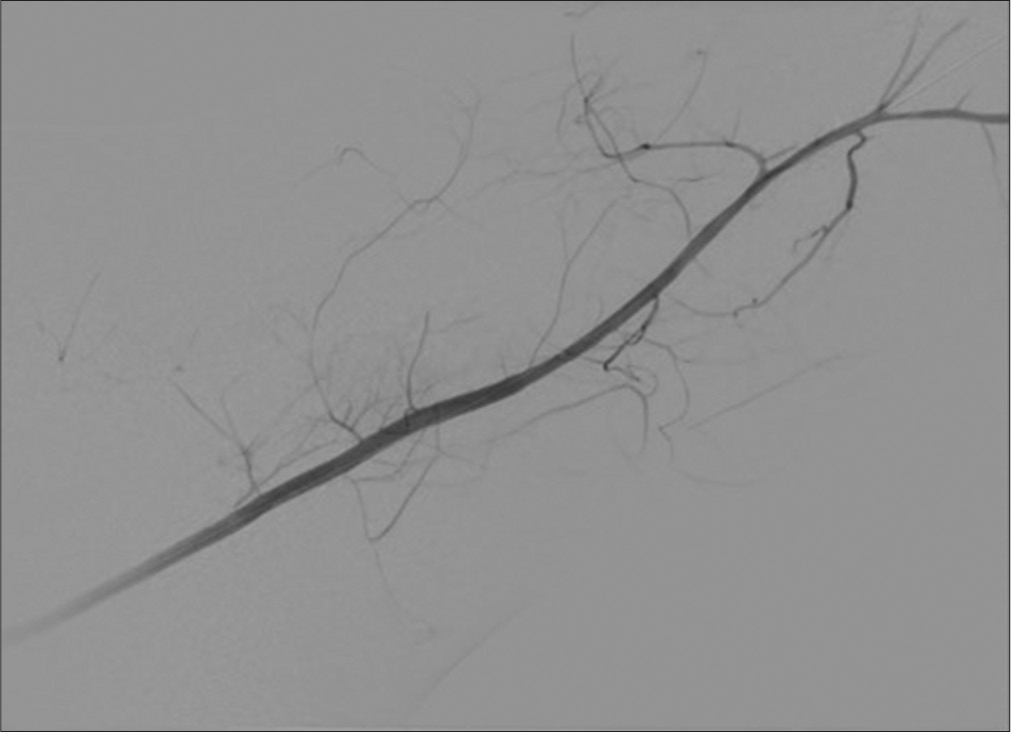 41 year-old male with axillary artery transection. Patent left brachial artery. No flow is present in the radial artery