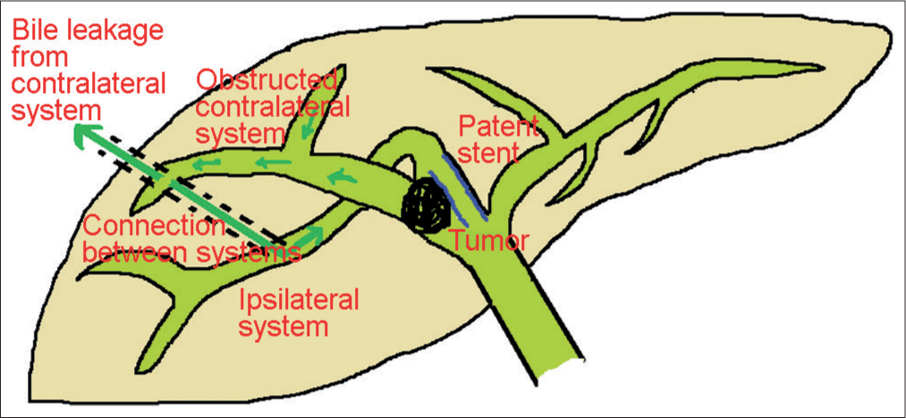 Skin bile leak after biliary decompression. (a) Mechanism of bile leak in the absence of stent occlusion. Note that bile fl ow appears when high-pressure bile of the contralateral system fi nds its way via trajectory line to the lower pressure sites e.g. to the skin surface and ipsilateral stented biliary system (dark green arrows).