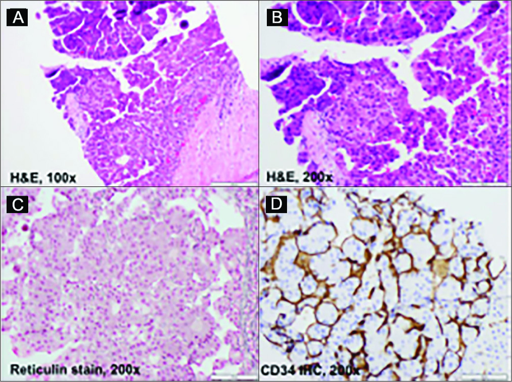 45-year-old man with well-differentiated hepatocellular carcinoma. Microscopic examination reveals liver tissue replaced by neoplastic enlarged hepatocytes demonstrating high nuclear to cytoplasm ratio, hyperchromatic nuclei with prominent nucleoli and irregular nuclear membrane, accompanied by occasional mitoses (A and B). These dysplastic cells were arranged in thickened cell plates, illustrated by a reticulin special stain, which is highly consistent with a neoplastic process (C). Immunostains (IHCs) performed on this biopsy demonstrate that these neoplastic cells are positive for hepatocytic antigen Heppar-1, CEA with clearly canalicular pattern, and weakly positive for alpha-fetoprotein (not shown here); CD34 IHC reveals marked endothelial wrapping of thickened cell plates (D). These findings support the diagnosis of well-differentiated hepatocellular carcinoma.