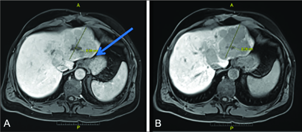 45-year-old man with well-differentiated hepatocellular carcinoma. Axial multiphasic MRI of the abdomen shows atypical imaging characteristics of HCC with minimal arterial enhancement (A) and lack of uptake on hepatobiliary phase imaging (B). No cirrhosis is identified and encroachment of the mass onto the lesser curvature of the stomach is seen (arrow). Notably, retrospective review of the images demonstrates no intrahepatic portal venous vasculature within either lobe.