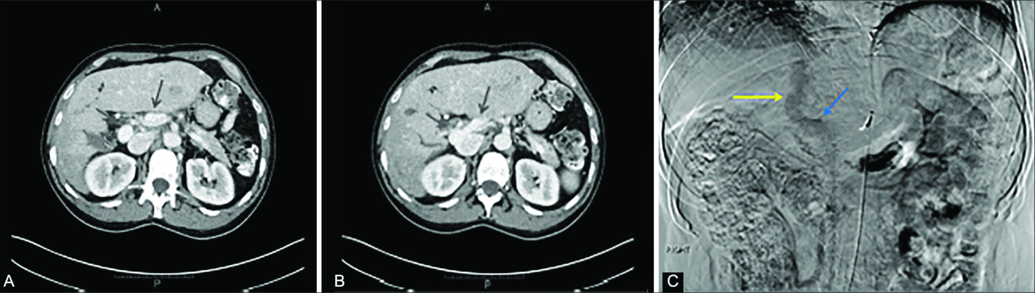 45-year-old man with well-differentiated hepatocellular carcinoma and congenital extra-hepatic portosystemic shunt (CEPS). Axial contrast enhanced CT images during portal venous phase demonstrate the relationship of the SMV (blue arrow), splenic vein (green arrow) and IVC (yellow arrow) inferior to the expected location of the portal confluence (A). More superiorly (B), the SMV (blue arrow) and splenic vein (green arrow) can be seen emptying directly into the IVC which has a large caliber (B), compatible with type IB CEPS. (C) Mesenteric phase after digital subtraction angiography via the superior mesenteric artery demonstrates direct drainage of the SMV (blue arrow) into the IVC (yellow arrow).
