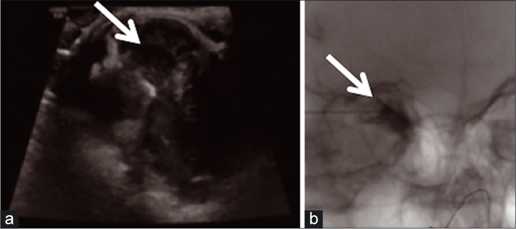 A 12-year-old female presented with eye pain and heaviness on eye movement. (a) Limited head-and-neck soft-tissue US in sagittal and transverse planes utilizing grayscale and color flow Doppler techniques for potential drainage. (b) US-guided aspiration of the right supraorbital lesion in interventional radiology (IR) (both arrows shows-Intraprocedural delineation of the MLM).
