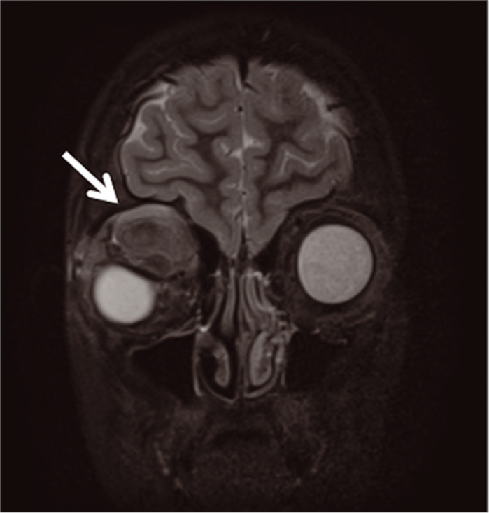 Coronal brain and orbits MRI with and without contrast s/p drainage of the right supraorbital mass (arrow delineates mixed signal intensity of right supraorbital mass with downward displacement of globe).