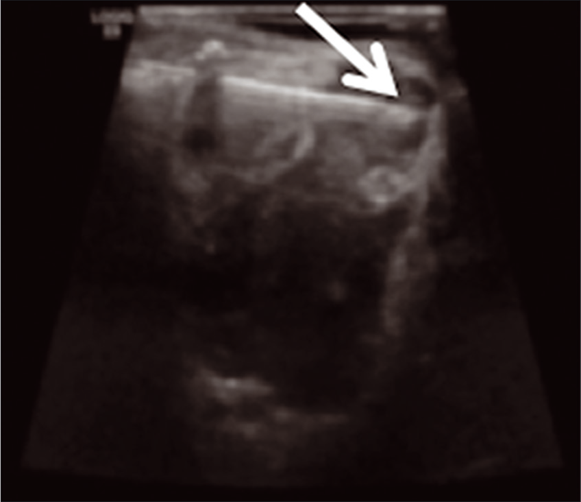 IR sclerotherapy s/p US-guided aspiration after mild magnetic resonance imaging interval enlargement of the right supraorbital microcystic lymphatic malformation (arrow shows-needle tip).