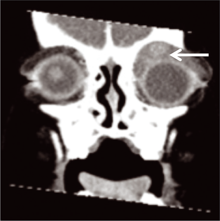 An 18-month-old female who presented with the left upper eyelid swelling. Coronal orbital computed tomography scan with contrast showing extensive soft-tissue swelling predominantly anterior to the left globe and orbit (arrow shows-lesion of interest).