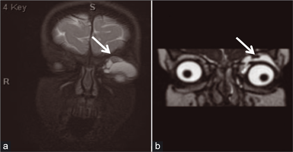 An 18-month-old female who presented with the left upper eyelid swelling. (a) Coronal orbital T2 Fiesta magnetic resonance imaging (MRI) and follow-up, (b) coronal orbital STIR MRI showing interval decrease in overall size of lesion (arrow delineates the left extraconal lesion).