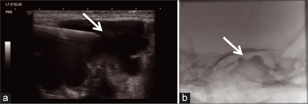 A 2-year-old female who presented on follow-up with return of the left upper eyelid swelling. (a) Interventional radiology (IR) limited US-guided aspiration and (b) IR sclerotherapy treatment without extravasation (arrows detail the lesion during US-guided aspiration and fluoroscopically-guided sclerotherapy of extraconal lesion).