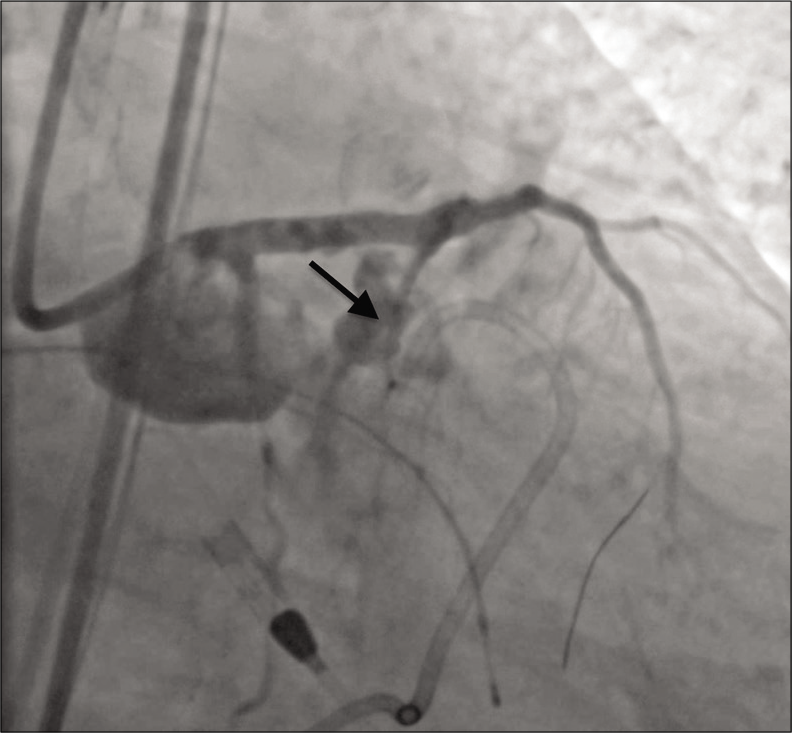 A 79-year-old male with 3 weeks of progressive dyspnea on exertion who was subsequently diagnosed with coronary artery disease involving the circumflex, right coronary, and left anterior descending arteries. Angiography showing active contrast extravasation (arrow) from the proximal left anterior descending coronary artery immediately following stent placement.