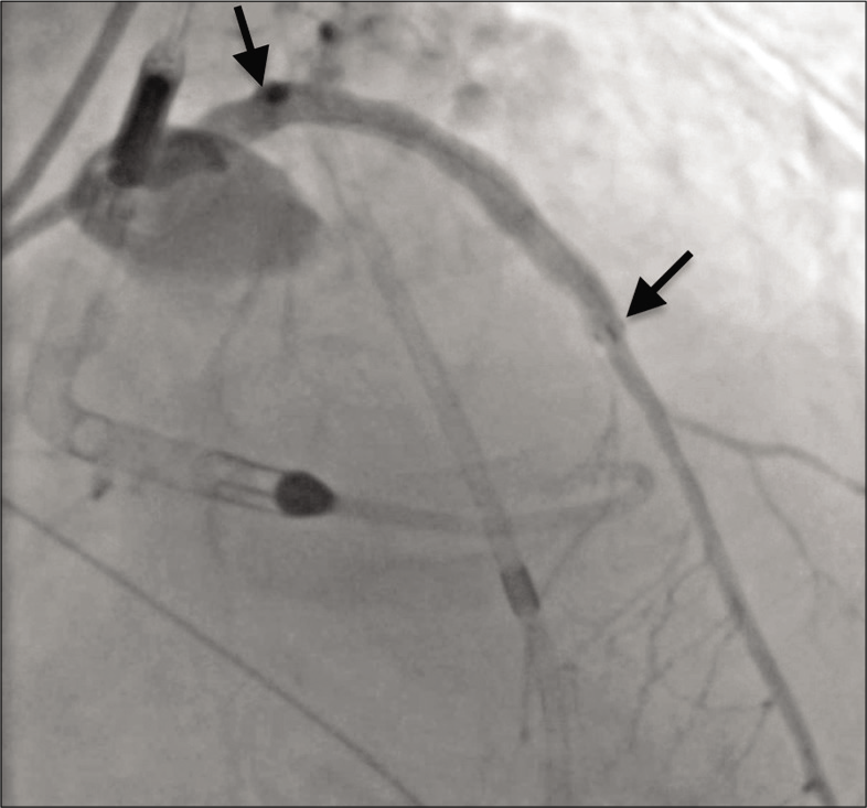 A 79-year-old male with 3 weeks of progressive dyspnea on exertion who was subsequently diagnosed with coronary artery disease involving the circumflex, right coronary, and left anterior descending arteries. Angiography showing resolution of contrast extravasation and excellent perfusion of the left anterior descending coronary artery after Viabahn stent graft placement (span of stent graft denoted by arrows).
