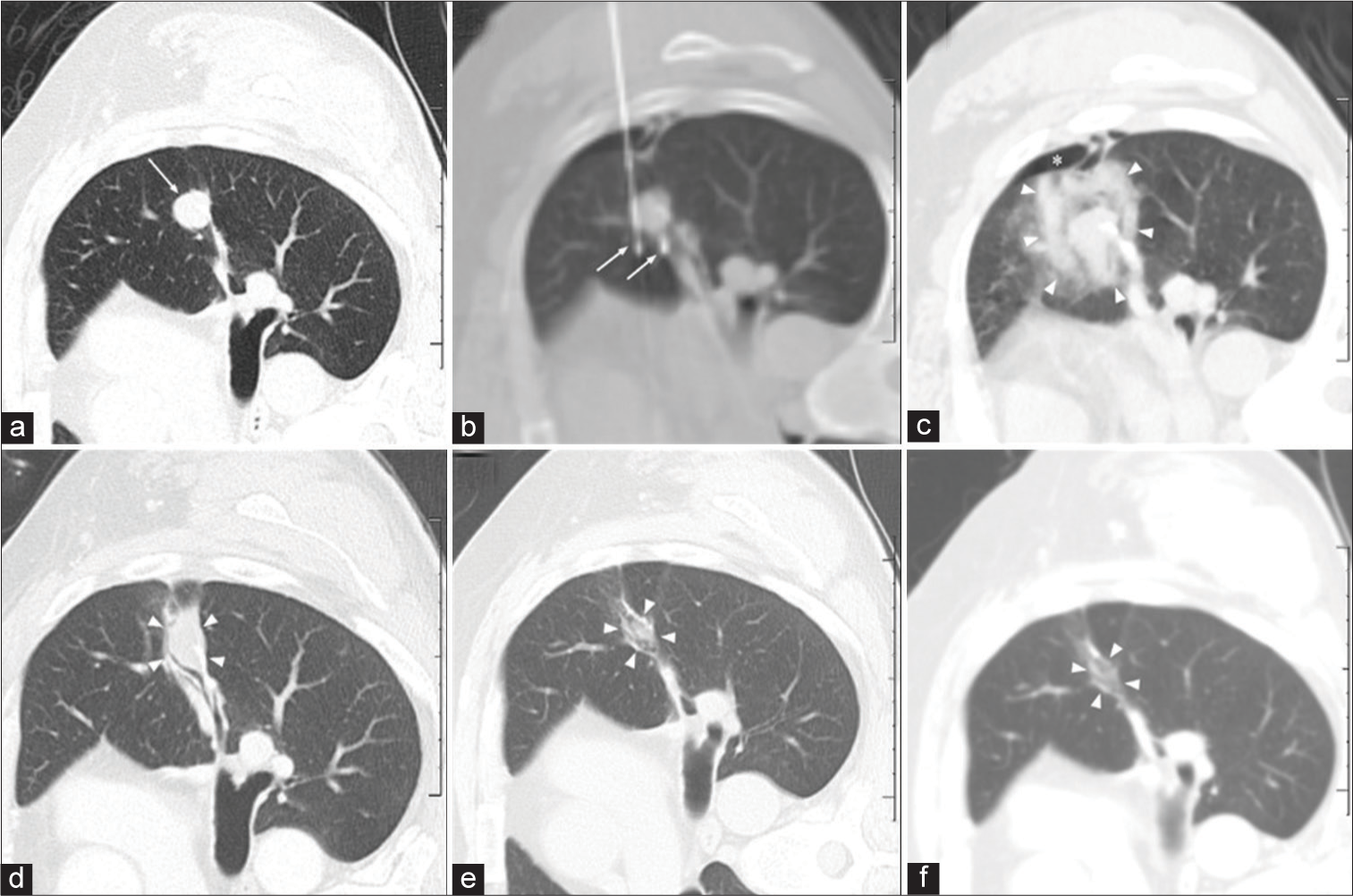 A 46-year-old man who initially presented with cough and underwent wedge resection for a left upper lobe non-small cell lung cancer. (a) CT lung window pre-procedure right lateral decubitus axial image shows left upper lobe pulmonary nodule (arrow) which was biopsy proven to be a post-surgical recurrence. (b) CT intraprocedure right lateral decubitus axial image with intermediate window (W: 1800, L: 200) demonstrates two cryoprobes (arrows) bracketing the left upper lobe nodule. (c) CT lung window post-procedure right lateral decubitus axial image shows the cloud of edema/hemorrhage (arrowheads) surrounding the low-density ice that extends symmetrically beyond the left upper lobe lung nodule margins. (d-f) CT lung window right lateral decubitus axial images at 1-, 3-, and 6-year follow-up, respectively, show progressive resorption of ablation zone with residual linear scar and no significant damage to remaining lung parenchyma. The thorough hypovascular appearance on soft-tissue window (not shown) helped confirm no residual recurrence at year 1 (d), despite the minimal initial resorption at that time.