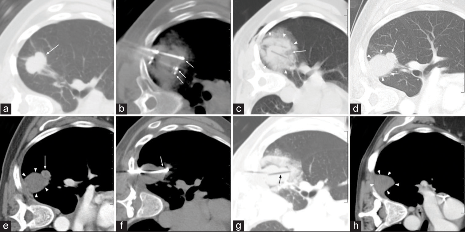 A 45-year-old woman who had an incidental lung mass found on CT for shortness of breath. (a) CT lung window pre-procedure left lateral decubitus axial image shows biopsy-proven right lower lobe lung cancer (arrow). (b) CT intermediate window (W: 1800, L: 200) intraprocedure left lateral decubitus axial image demonstrates multiple cryoprobes (arrows) in the right lower lobe mass during early freeze. The intermediate window utilized here allows for better visualization of the probes, ribs, and mass at one time. (c) CT lung window post-procedure left lateral decubitus axial image shows a cloud of edema/hemorrhage surrounding right lower lobe mass (arrowheads), but focal gap in the cloud is <1 cm from tumor (arrow). (d and e) CT lung and soft-tissue window, respectively, 3-month follow-up left lateral decubitus axial images show focal nodular enhancing recurrence along anterolateral margin (white arrow) of the remaining avascular ablation zone (arrowheads). (f) CT soft-tissue window intraprocedure left lateral decubitus axial image of recurrence reablation shows multiple probes extending anterior through ablation zone and beyond nodular recurrence (arrow). (g) CT lung window post-procedure left lateral decubitus axial image of recurrence ablation now shows cryoprobe track extending through nodular recurrence (black arrow). (h) Contrast-enhanced CT soft-tissue window left lateral decubitus axial image at 1 year follow-up of recurrence ablation shows thorough avascular ablation zone (arrowheads).