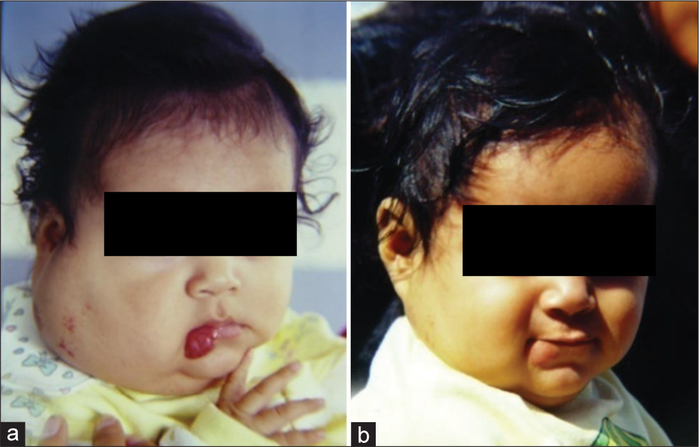 (Case 2): A 5-month-old baby girl with a right mixed parotid/cheek IH. (a) Pre and (b) 4 months post TAE. Surgical excision had been scheduled after embolization. The mother refused surgery due to the rapid and progressive shrinking of the tumor post TAE.