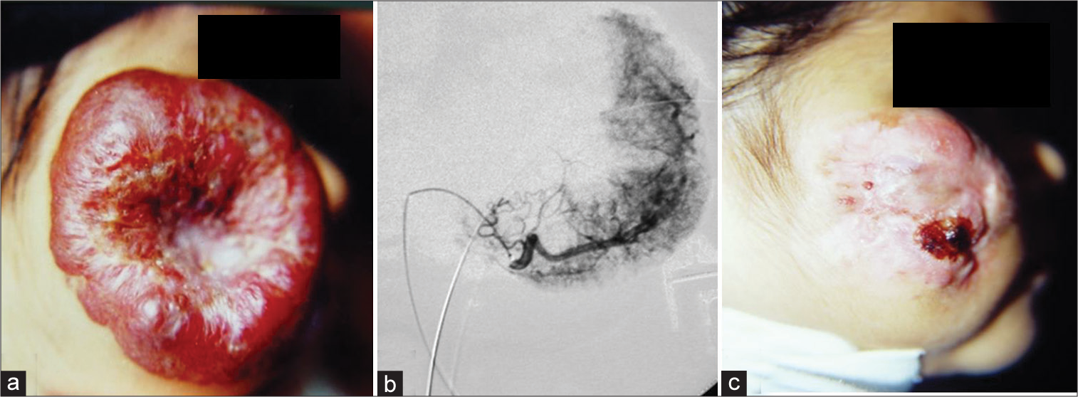 (Case 6): A 9-month-old girl with a large superficial non-involuting congenital cheek IH with a doughnut appearance. She had had intratumoral injections of triamcinolone in another institution, developing central tumor necrosis. (a) Before TAE. (b) Superselective endovascular PVA injection in the facial artery. (c) Clinical picture at 5 months’ follow-up showed dramatic regression of the tumor. Patient was sent to Cosmetic Surgery for skin grafting.