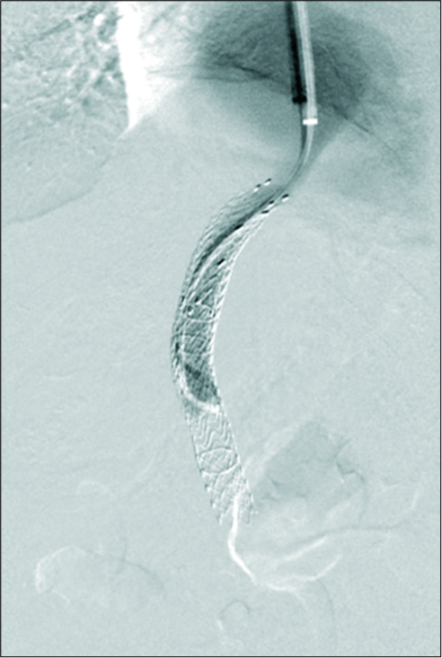 A 61-year-old female with chronic transjugular intrahepatic portosystemic shunt (TIPS) dysfunction and systemic lupus erythematosus-induced cirrhosis presented with variceal bleeding, occluded TIPS, and an arterioportal fistula. TIPS venogram following stent extension shows brisk flow.