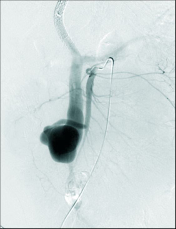 A 61-year-old female with chronic transjugular intrahepatic portosystemic shunt (TIPS) dysfunction and systemic lupus erythematosus-induced cirrhosis presented with variceal bleeding, occluded TIPS, and an arterioportal fistula. Selective angiography of the superior mesenteric artery shows a large arterioportal fistula with the superior mesenteric vein.