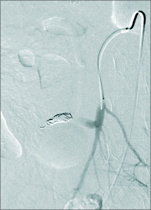 A 61-year-old female with chronic transjugular intrahepatic portosystemic shunt (TIPS) dysfunction and systemic lupus erythematosus-induced cirrhosis presented with variceal bleeding, occluded TIPS, and an arterioportal fistula. Successful embolization of the arterioportal fistula with 9 mm microvascular plug, five 7 mm × 30 mm Concerto detachable coils, and 1 cc Gelfoam slurry using a sandwich technique.