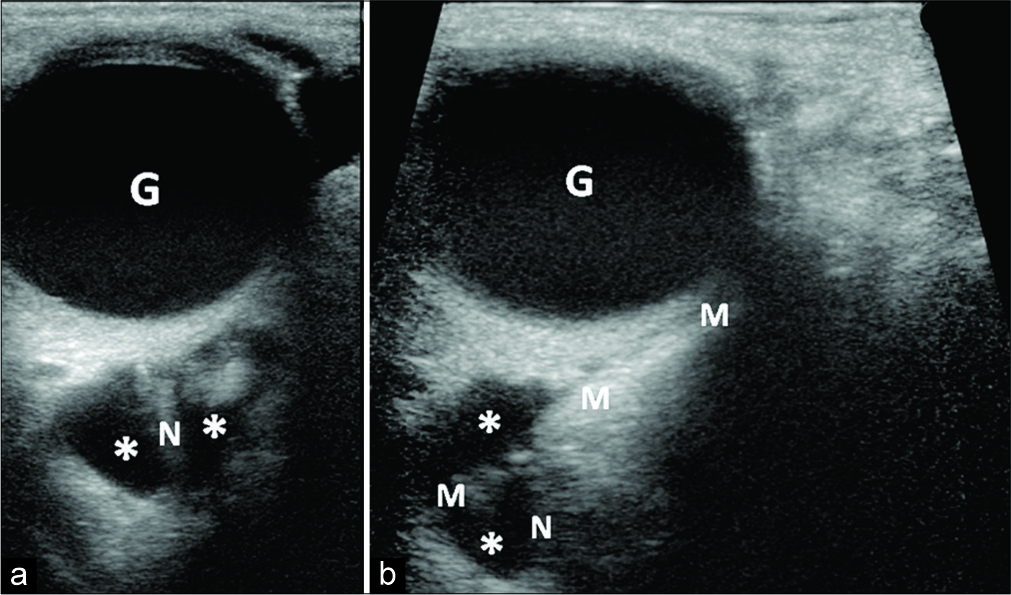 6 year-old girl presenting with painless right orbital swelling. (a) Grayscale ultrasound of the orbit performed the day of sclerotherapy demonstrates a significant decrease in the size of LM macrocysts (*) with the dominant cyst surrounding the optic nerve (N). (b) Ultrasound-guided micropuncture needle (M) access of the LM cyst (*) using a medial approach (G = globe).ls (*) that surround the optic nerve (N).