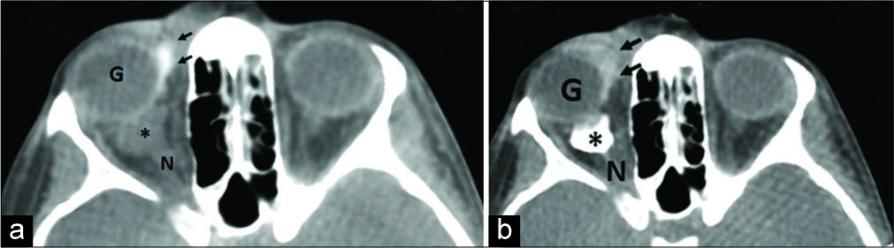 6 year-old girl presenting with painless right orbital swelling. (a) Cone-beam CT demonstrates the small LM cyst (*) with sclerosant already injected (arrow) into the LM tissue medial to the globe (G). (b) Conebeam CT following completion of sclerotherapy shows adequate deposition of sclerosant (*) in the residual LM cyst (N = optic nerve).