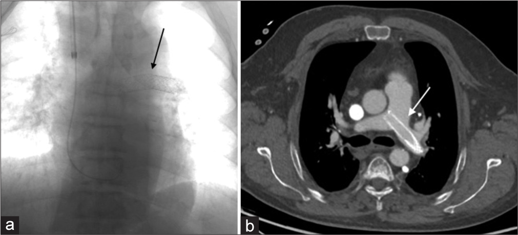 (a) A 52-year-old patient with the right brachiocephalic and proximal superior vena cava (SVC) stenosis treated with two over-balloon stents, which migrated to the left pulmonary artery. Fluoroscopy showing the dislodgement of the stents into the main pulmonary trunk and the left pulmonary artery (arrow). (b) A 52-year-old patient with the right brachiocephalic and upper SVC stenosis treated with two over-balloon stents, which migrated to the left pulmonary artery. Axial CT scan of the chest with contrast showing the migrated stents located in the main pulmonary trunk and the left pulmonary artery (arrow).