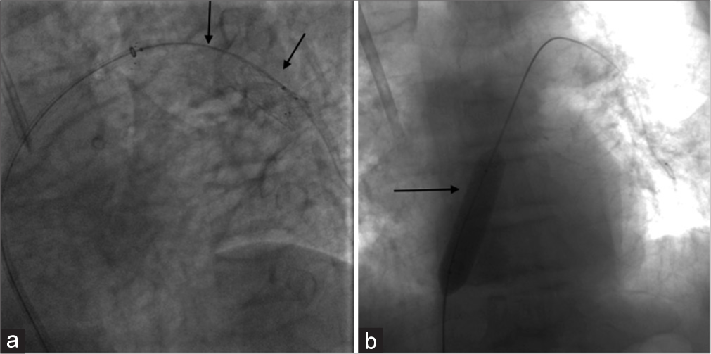 (a) A 52-year-old patient with the right brachiocephalic and upper superior vena cava (SVC) stenosis treated with two over-balloon stents, which migrated to the left pulmonary artery. Fluoroscopy showing the introduction of a 12 mm × 80 mm Power Flex angioplasty balloon over the Amplatz Stiff guide wire into the migrated stents (arrows). (b) A 52-year-old patient with the right brachiocephalic and upper SVC stenosis treated with two over-balloon stents, which migrated to the left pulmonary artery. Fluoroscopy showing the migrated stents after being captured over the inflated 12 mm × 80 mm Power Flex angioplasty balloon (arrow) and successfully pulled into the right atrium.