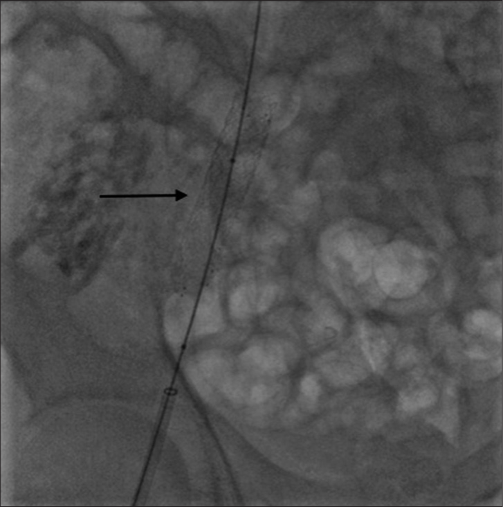 A 52-year-old patient with the right brachiocephalic and upper superior vena cava stenosis treated with two over-balloon stents, which migrated to the left pulmonary artery. Fluoroscopy of the right side of pelvis showing the two stents after being successfully inflated and deployed in the right common and external iliac veins (arrow) where they were left.