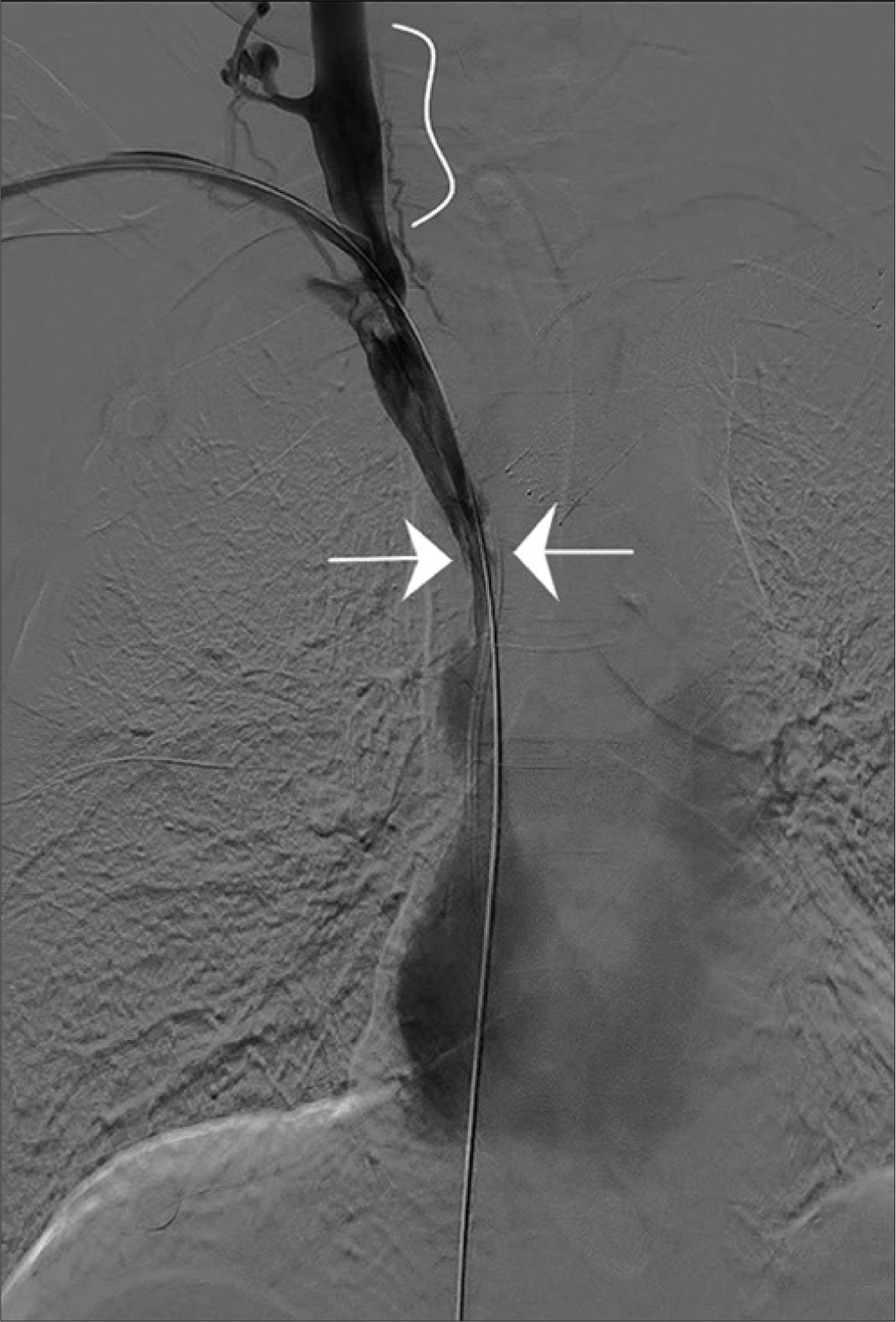 73-year-old male with end-stage renal disease and colon cancer who presented with facial swelling secondary to superior vena cava syndrome. Fluoroscopic contrast enhanced venography image shows reflux (bracket) of contrast into the right internal jugular secondary to central obstruction of superior vena cava (arrow).