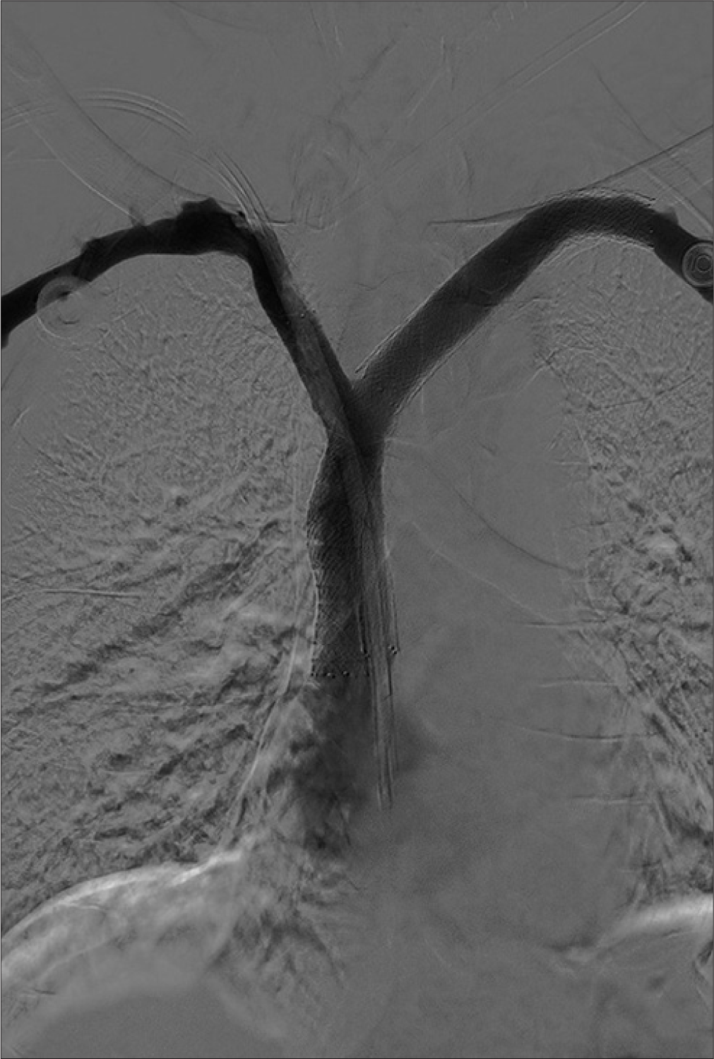 73-year-old male with end-stage renal disease and colon cancer who presented with facial swelling secondary to superior vena cava syndrome. Fluoroscopic contrast enhanced venography image at completion of procedure.