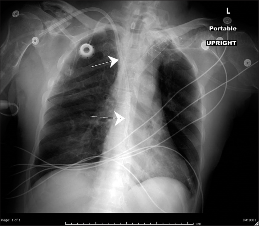 73-year-old male with end-stage renal disease and colon cancer who presented with facial swelling secondary to superior vena cava syndrome. (a) Post-procedural day one chest radiograph demonstrating right internal jugular tunneled hemodialysis catheter (arrow) and chemotherapy port (arrow) traveling along the course of the right brachiocephalic-superior vena cava stent.