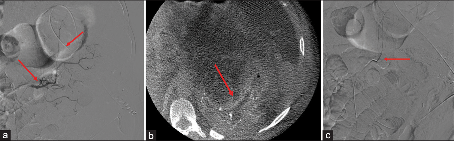 (a) A 57-year-old status post-partial nephrectomy for intraoperatively diagnosed xanthogranulomatous pyelonephritis. The left renal arteriography demonstrated unusual branching (arrow) from the left renal artery and no well-defined renal parenchyma. (b) Cone-beam computed tomography demonstrates enhancement within the operative bed (arrow) in the expected location of the residual left kidney. (c) Angiogram demonstrated a proximally originating accessory branch (arrow) that was incompletely treated with the initial embolization.