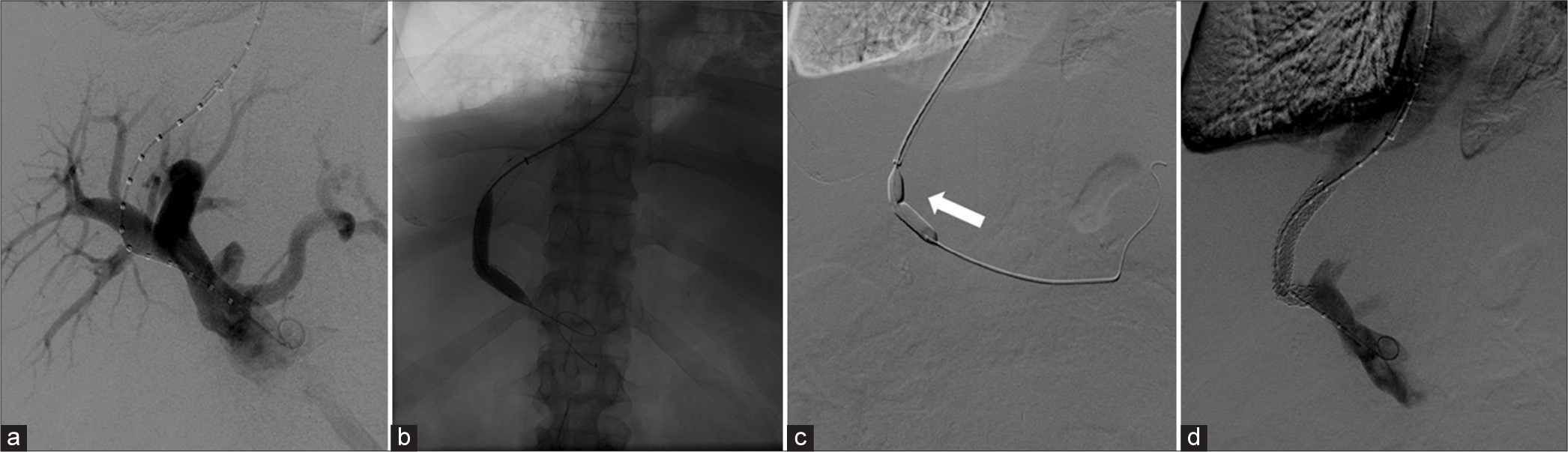 A 57-year-old male diabetic and alcoholic cirrhotic patient, on transplant list, with diagnosis of coronavirus, presented with variceal bleeding. Hepatic angiography shows the introduction of pigtail catheter to measure the stent (a) and a pre-dilatation of the transhepatic path (b). Stent implantation was performed, followed by dilatation of the TIPS stent with 10 mm balloons (arrow) (c). Post-venoplasty showed improvement in portosystemic gradient (d).