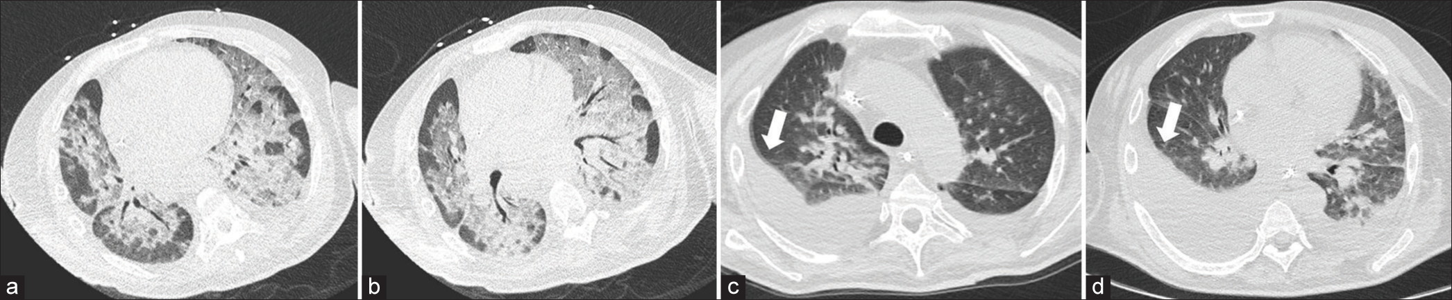 A 57-year-old male diabetic and alcoholic cirrhotic patient, on transplant list, with diagnosis of coronavirus (COVID-19), presented with variceal bleeding. Pre-TIPS computed tomography with lung window demonstrating a pattern of severe involvement of the lung parenchyma compatible with COVID-19, presenting opaque opacification in bilateral ground-glass diffuse (a and b). Post-TIPS computed tomography with lung window after 2 weeks demonstrating decreasing of lung involvement, with less ground-glass opacification, but bilateral pleural effusion (arrows) (c and d).