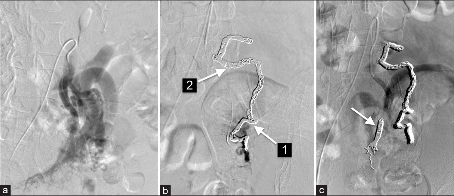 A 72-year-old male with a colonic arteriovenous malformation (AVM) who presented with ascites. Intraoperative angiography of the inferior mesenteric artery (IMA) shows (a) multiple engorged vessels supplying the AVM, (b) significant reduction of flow into the AVM after the placement of embolization coils, coils were placed through both the IMA (arrow 1) and the superior mesenteric artery (arrow 2), and (c) an embolization coil (arrow) placed in an additional prominent vessel that connected the IMA to the AVM.
