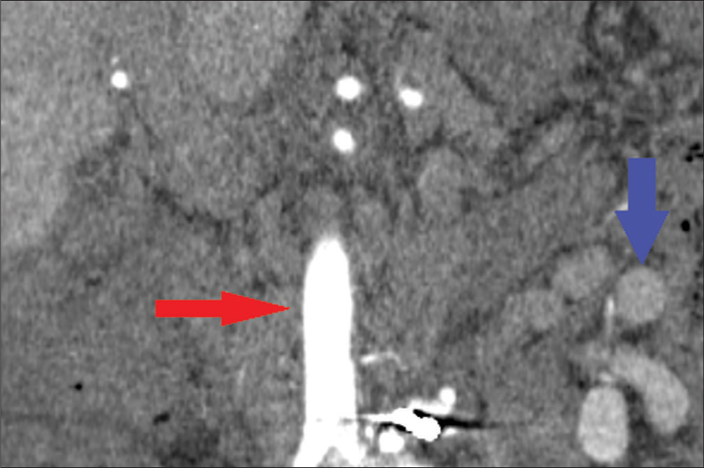 A 72-year-old male with a colonic arteriovenous malformation who presented with ascites. Contrast-enhanced CT image of the abdomen in arterial phase demonstrating the contrast enhance aorta (red arrow) and the draining portal vein nearly absent of contrast (blue arrow) suggesting marked reduction in arterial blood supply post-procedurally.